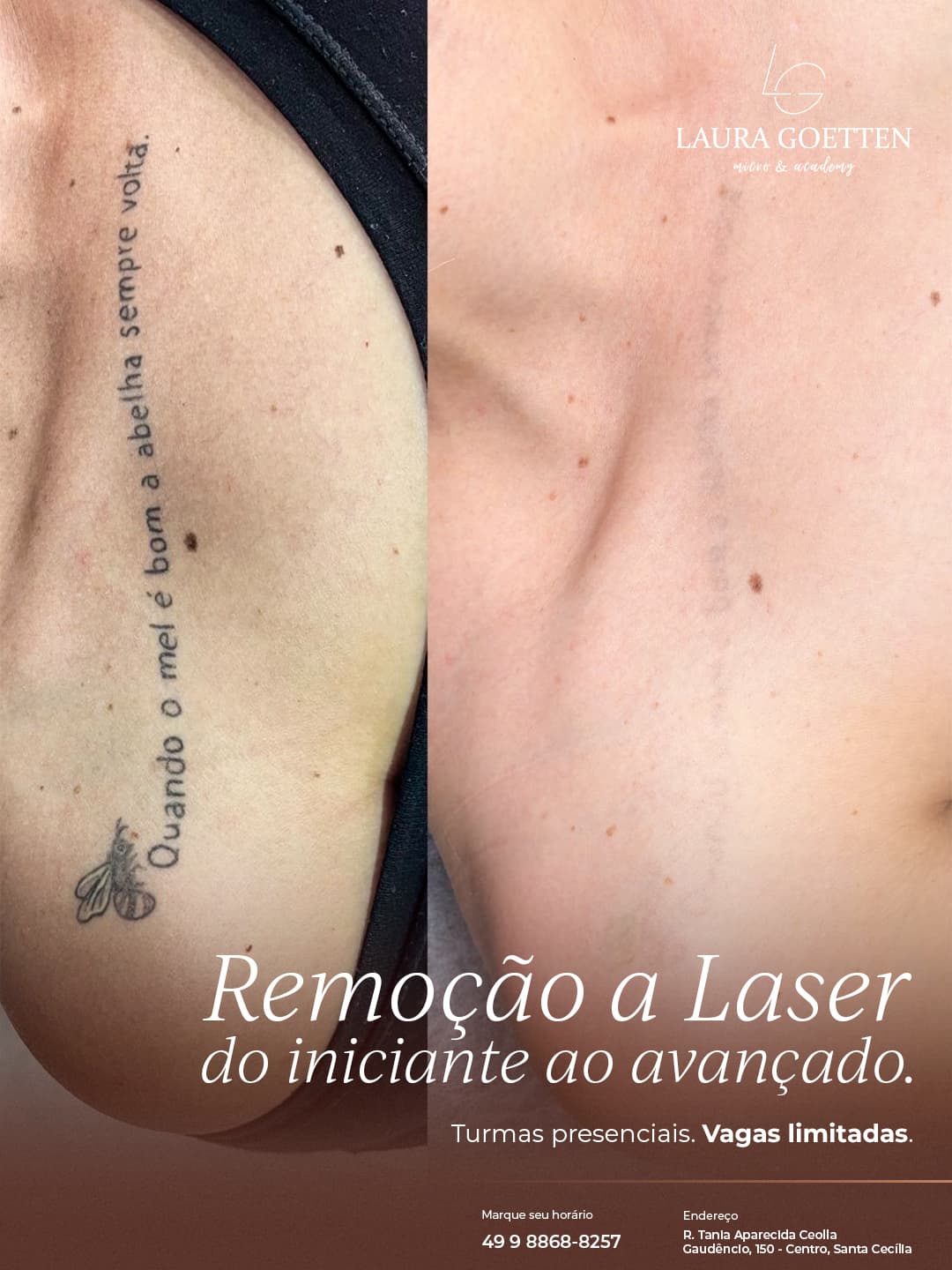 Remoção de Tatuagem