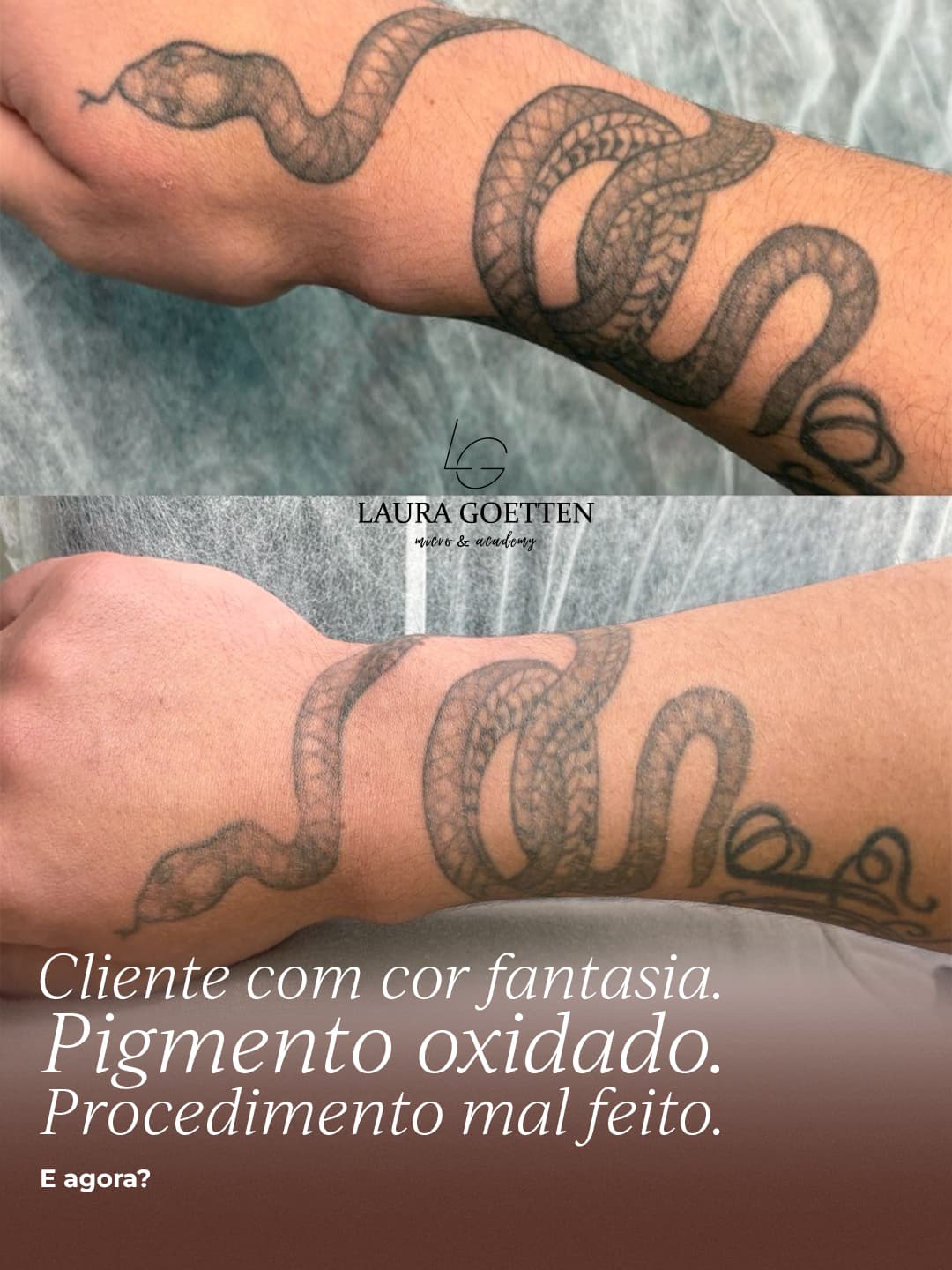 Remoção de Tatuagem